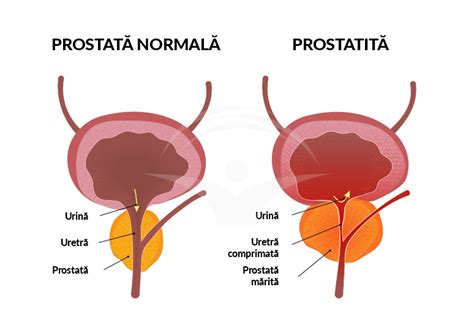 Ce Simptome Dau Calcifierile La Prostata Prostaffect N Rom Nia Hot