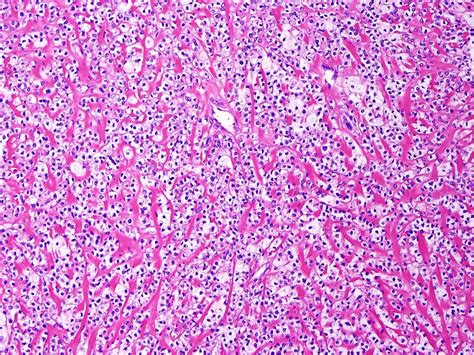 Pathology Outlines Perivascular Epithelioid Cell Tumor Pecoma