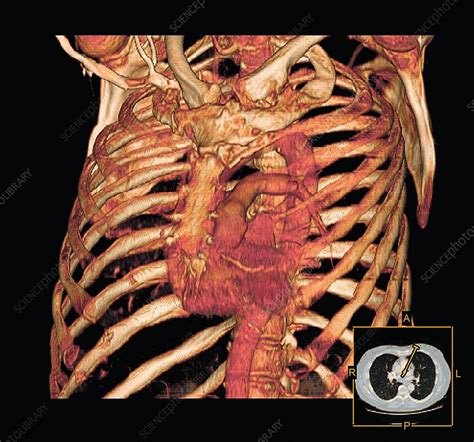 Ribcage And Blood Vessels 3d Ct Scan Stock Image C0104623