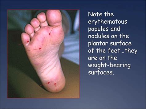 Sudden Painful Bumps On The Feet Of A Child