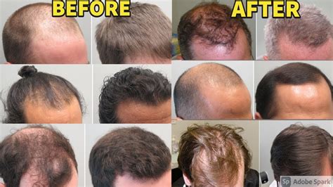 Beforeafter Results Of Finasteride And Minoxidil Users For Treating