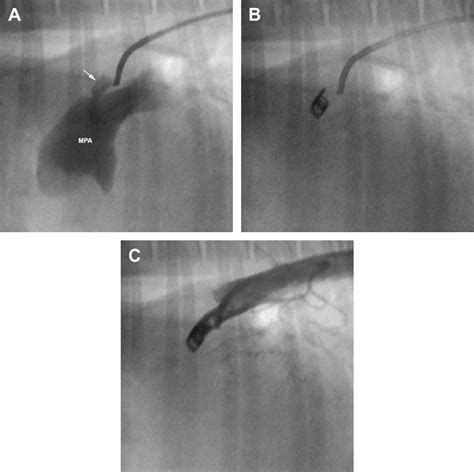 Figure 2 From Minimally Invasive Per Catheter Occlusion And Dilation