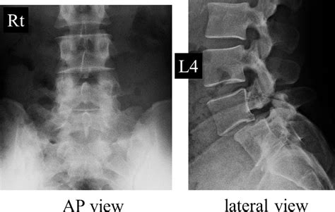 Successful Endoscopic Surgery For L5 Radiculopathy Caused By Far