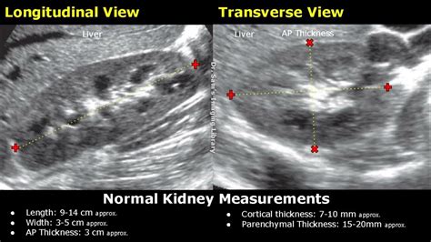 How To Measure Kidney On Ultrasound Renal Length Width Ap Thickness