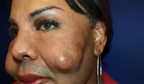 Botched Transgender Womans Face Exploded After Having Cement Injected