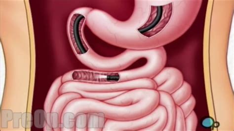 Patient Case Scenario Upper Gastroinstestinal Endoscopy Youtube