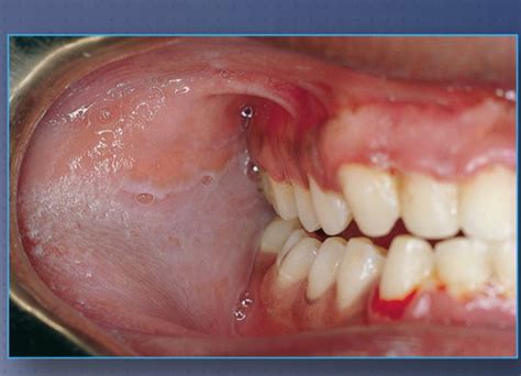 Oral Pathology White Lesions Flashcards Quizlet