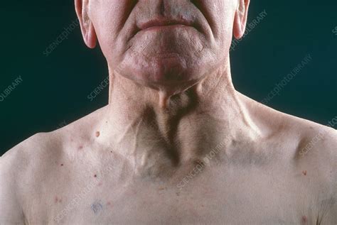 Goiter Stock Image C0144419 Science Photo Library