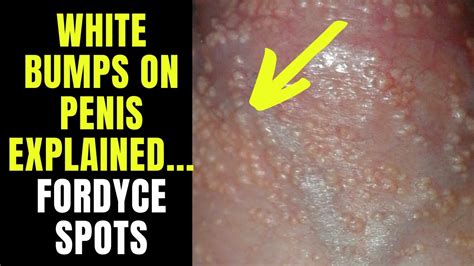 Doctor Explains Fordyce Spots Granules Small White Spots Or Pimples On The Penis Youtube