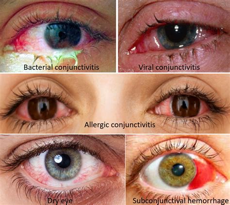 Causes And Precautions For Red Eyes Know The Alert Signs Drvarsha