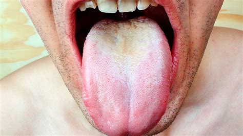 25 How Do I Know If I Have Herpes On My Tongue 308334 How Do I Know