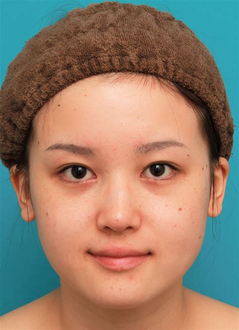 顔専用脂肪溶解注射とエラボツリヌストキシンで小顔になった20代女性の症例写真：美容外科 高須クリニック