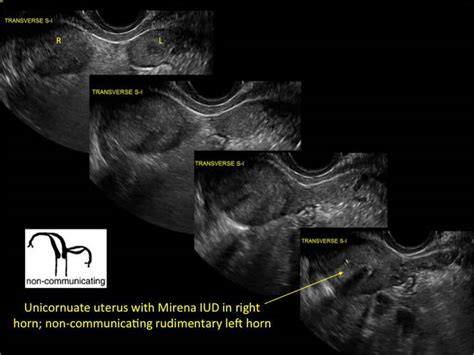 unicornuate uterus ultrasound images E START サーチ