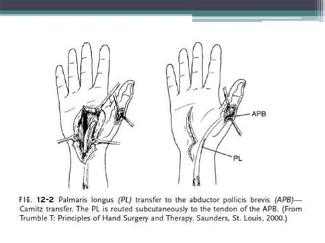 Pre And Post Operative Management In Tendon Transfer
