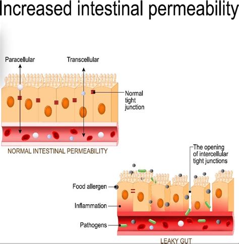 Leaky Gut Syndrome Ibs Dysbiosis Weight Loss Resistance Nutrition