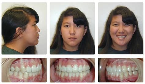 Braces Before And After Overbite Favourite Dentistry