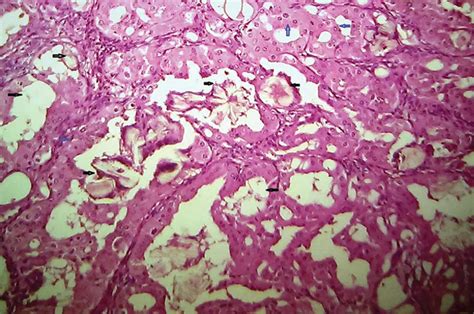 Acquired Cystic Kidney Disease Associated Renal Cell Carcinoma A Case