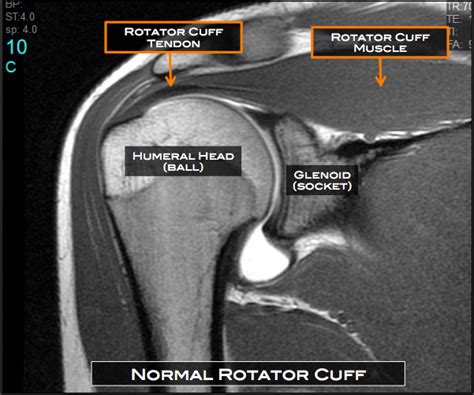 Rotator Cuff Tear Austin Tx Shoulder Surgery Austin Tx Shoulder