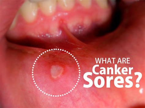 Canker Sores Or Aphthous Ulcers Are Shallow Painful Sores Inside The