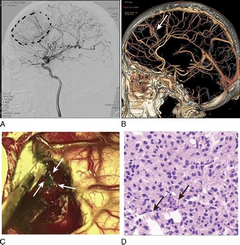 A Patient With A Small Amount Of Subarachnoid Hemorrhage In The Frontal