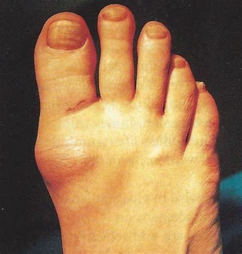 Stiff Big Toe Hallux Rigidus