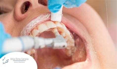 Limpieza Dental Para Una Buena Salud Oral Torres Carranza