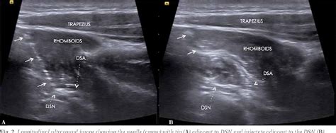 Figure From Dorsal Scapular Nerve Entrapment Neuropathy Managed By