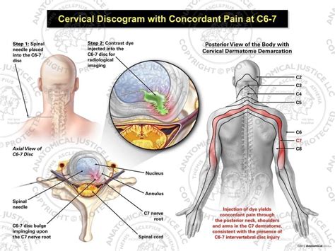 Cervical Radiculopathy Treatment