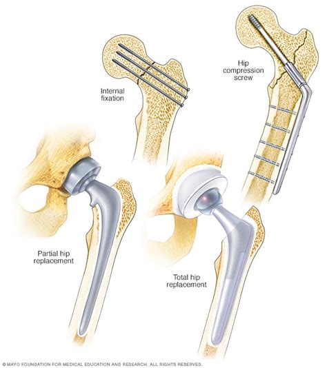 Hip Fracture Diagnosis And Treatment Mayo Clinic