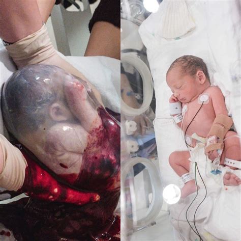 This Photo Of A Baby Being Born Inside Its Amniotic Sac Is Incredible
