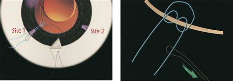 Figure 8 From Transscleral Suture Technique For Fixation Of A Dislocated Posterior Chamber
