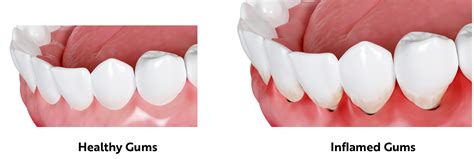 Why Are My Gums Swollen Diamond Dental Group