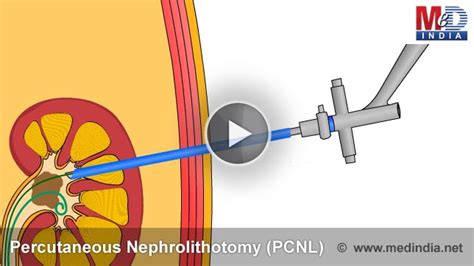 Animation On Key Hole Surgery For Kidney Stone Removal Or Percutaneous