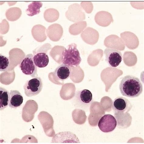 Bone Marrow Biopsy Revealing Hyperplastic Anemia Download Scientific