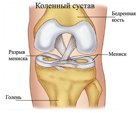 Операция при разрыве мениска Фото до и после операция отзывы лечение реабилитация и