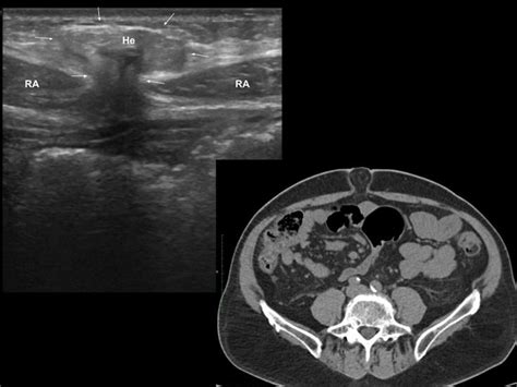 Epigastric Hernia Ultrasound And Ct Images Of Two Patients With
