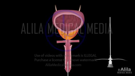 Alila Medical Media Transurethral Resection Of The Prostate Medical Illustration