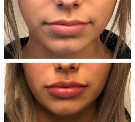 Juvederm Lips Before And After