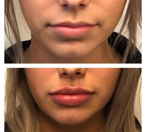 juvederm lips before and after