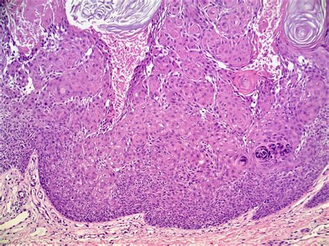 Pathology Outlines Inverted Follicular Keratosis Sexiz Pix