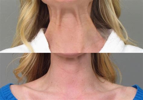Botox For Neck Bands Soliderma
