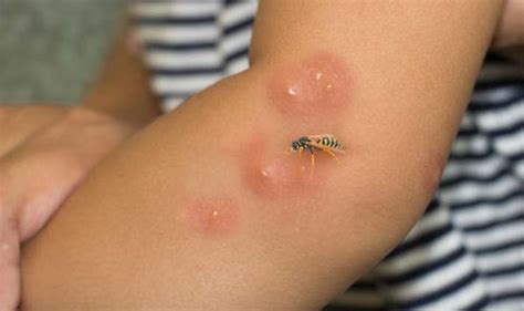Wasp Sting How To Identify It Avoid It And What To Do