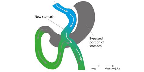 Laparoscopic Gastric Bypass And One Anastamosis Loop Gastric Bypass South Tees Hospitals Nhs