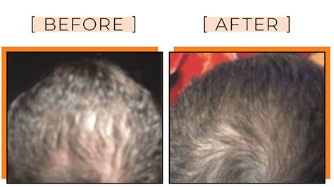 Hair loss treatments available to patients get better and better as time goes on. PRP Gallery | PRP Hair Treatment