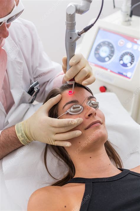 Vascular Laser Treatment Stock Image C0478794 Science Photo Library
