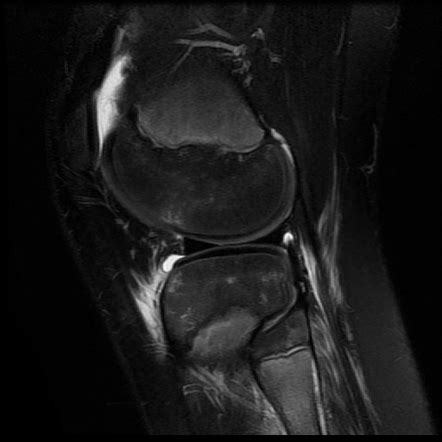 Hyperextension Knee Injury Radiology Case Radiopaedia Org