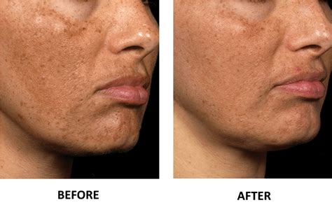 Laser Skin Resurfacing In Virginia Beach Fraxel Laser Treatment For Body