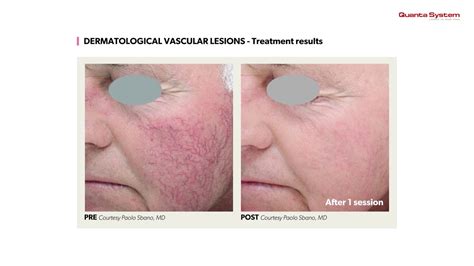 Quanta System Dermatological Vascular Lesions Treatment Results