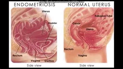 If you have endometriosis, you know how miserable it can be. Treatment For Endometriosis Review | Is Treatment For ...