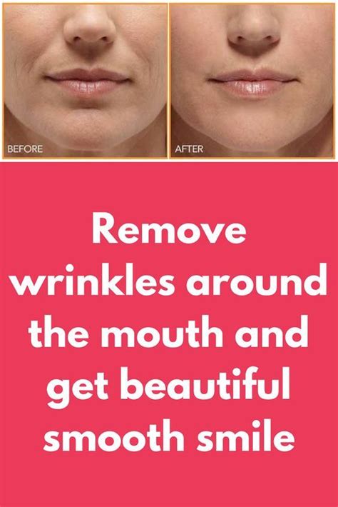 Remove Wrinkles Around The Mouth And Get Beautiful Smooth Smiile Star
